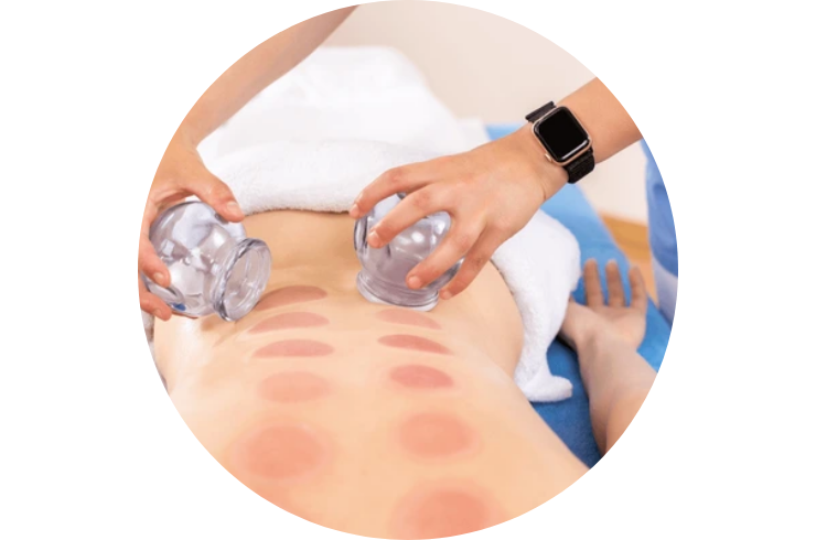 Cupping Therapy----------13